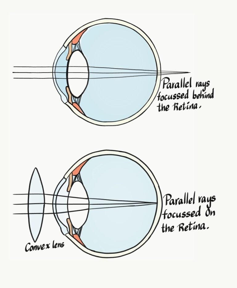 A Complete Overview Of Hypermetropia (Farsightedness) - Medrenaline