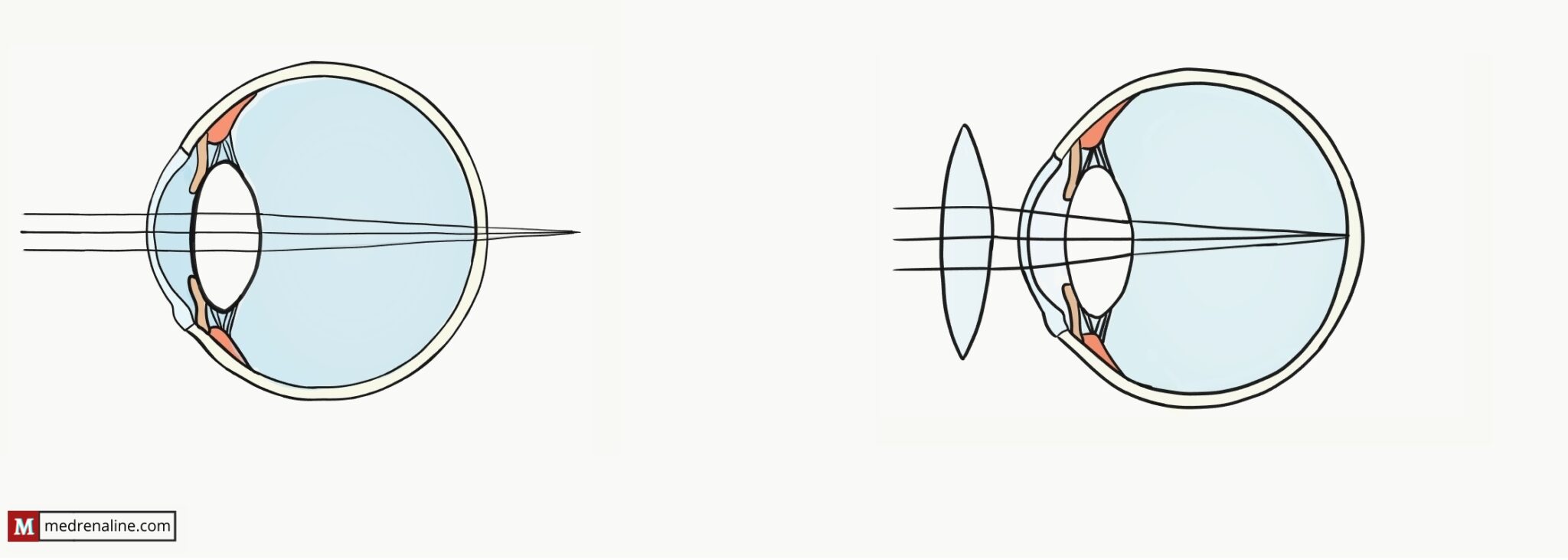 a-complete-overview-of-hypermetropia-farsightedness-medrenaline